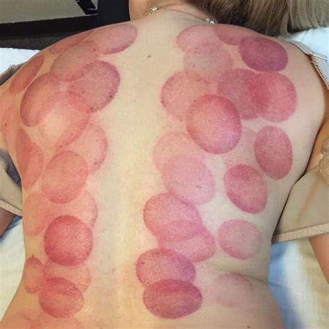 “Cupping for back pain, tension, and stagnation. #cupping #acupuncture ...