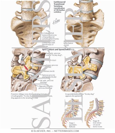 Lumbosacral Transitional Vertebrae; Spondylolysis and Spondylolisthesis