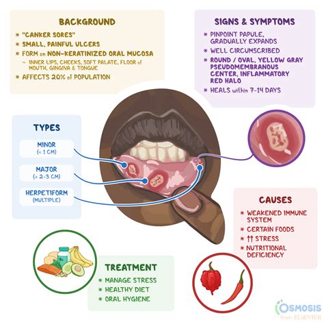 Aphthous Stomatitis: What Is It, Symptoms | Osmosis