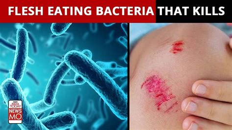 Necrotizing Fasciitis Bacteria Causes