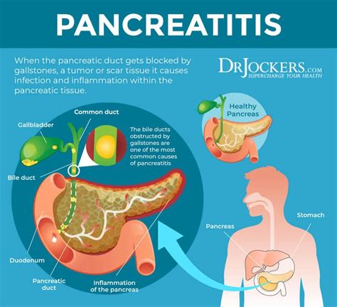 Can Gallbladder Cause Back Pain - Cares Healthy