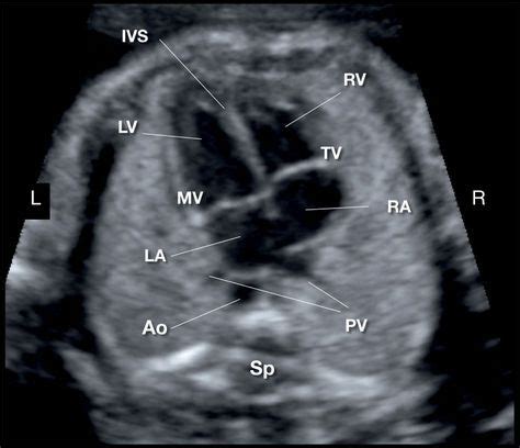 images | Cardiac sonography, Ultrasound, Medical ultrasound