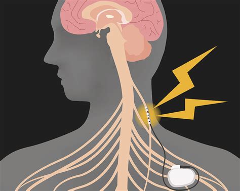 Vagus Nerve Stimulation in Pediatric Epilepsy: Weighing the Risks and ...