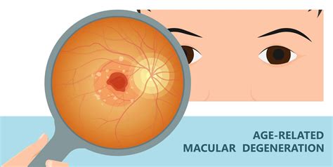 Age-Related Macular Degeneration (AMD) - Chelvin Sng Eye Center ...