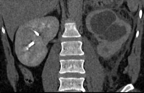 Pyonephrosis Left Kidney due to Obstructing Stone in Ureter - Kidney ...