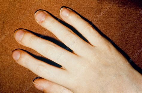 Finger clubbing - Stock Image - C004/8259 - Science Photo Library