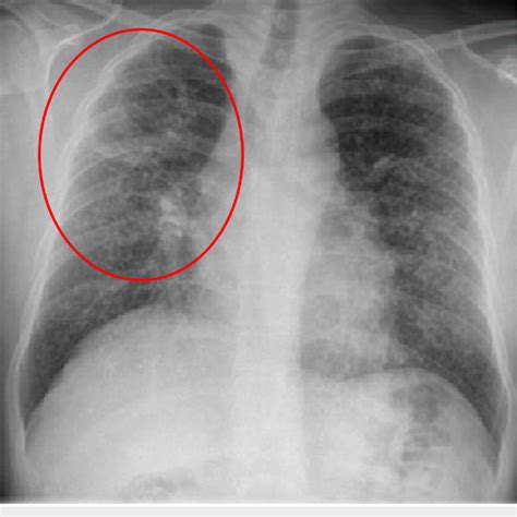 Chest radiograph showing right upper lobe cavitary lung lesion and ...