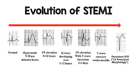 Pathway Stemi