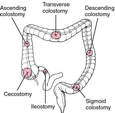 Medical Arts Pharmacy Fayetteville Arkansas: Colostomy Medical Definition