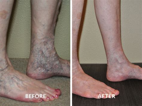 Varicose Vein Treatment Gallery | Advanced Vein Therapy