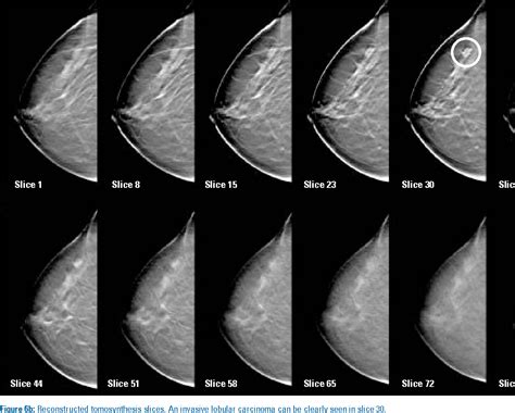 [PDF] Full-field breast tomosynthesis. | Semantic Scholar