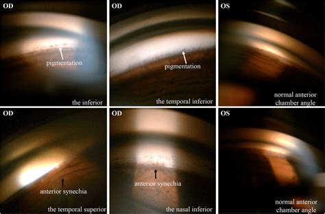 Gonioscopy. Massive pigmentation was detected in the chamber angle of ...