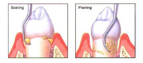 Deep Cleaning Your Teeth: When To Do It - Gorbatov Dentistry – Your ...