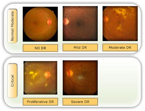 Diabetic Retinopathy Stages