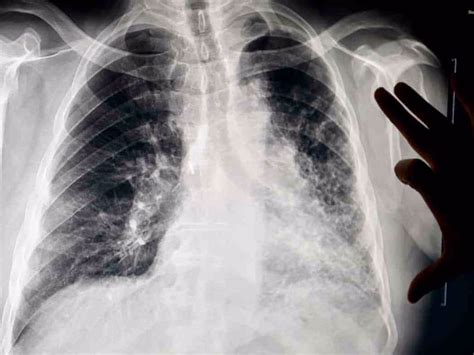 Lung Cancer From Asbestos Symptoms