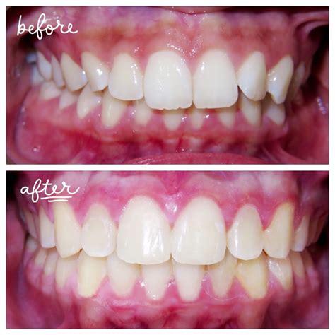 When Do You Start Seeing Results With Invisalign? | Hawley Orthodontics