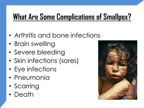 Smallpox Symptoms