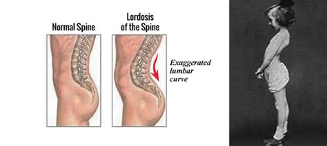 Lordosis Is A Common Treatable Condition in Kids & Adults