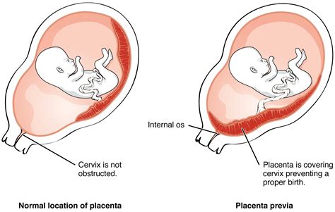 Anomalías de la Placenta | Concise Medical Knowledge