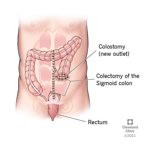 Hartmann's Pouch Procedure (Proctosigmoidectomy): Definition, Overview ...