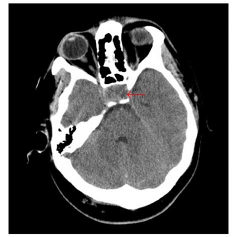 T1 SAG SELLA (MRI brain with and without contrast). Red arrow ...