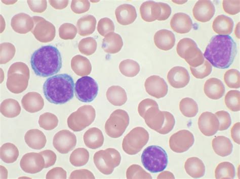 Leukemia - Pathology - Orthobullets