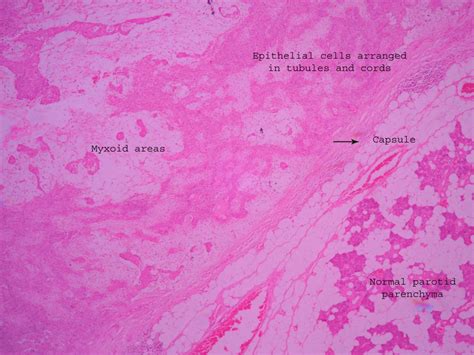 Pleomorphic adenoma – Histopathology.guru