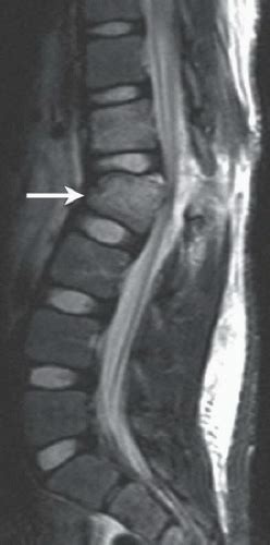 Chance Fracture | Radiology Key