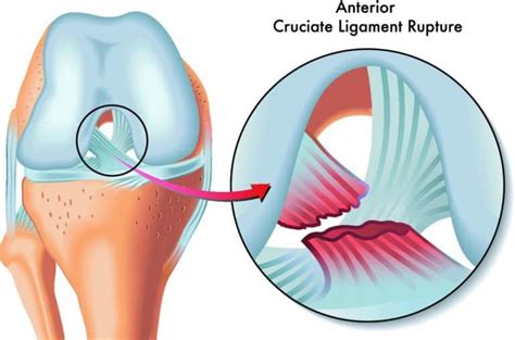 What on earth is a knee ACL tear? (and how to get rid of it) - Injury ...