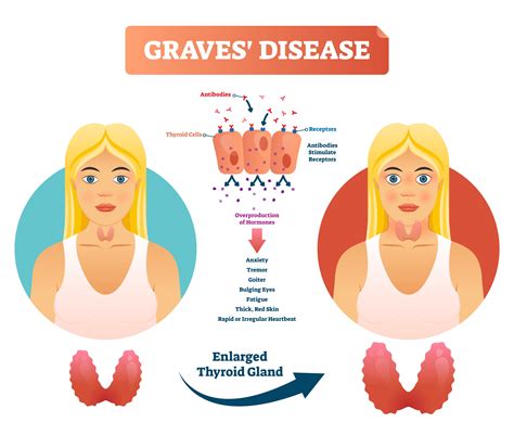 Graves’ Disease Eyes (Thyroid Eye Disease) | John A. Moran Eye Center ...