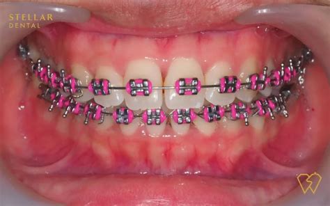 Braces Colors: Top Picks For 2023 - Stellar Dental