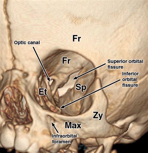 Superior Orbital Fissure Radiology