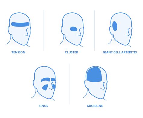 Headache Types Back Of Head