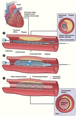 Coronary stent - Wikipedia