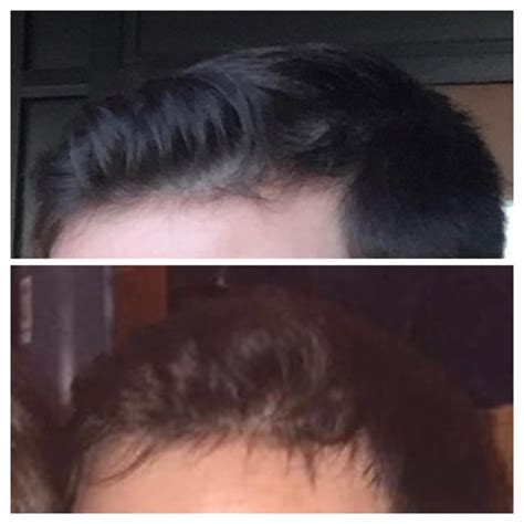 7+ years on just finasteride - Before and after. Details in comments ...