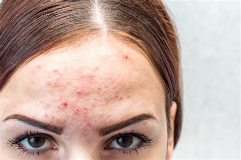 Pimples on forehead: What are the Causes & Treatments?