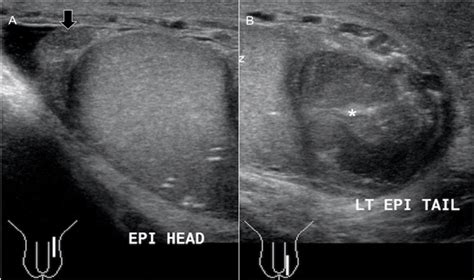 Ultrasound images (A & B) of the left scrotum. The sagittal view of the ...