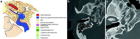 of the Jugular Foramen | Radiology Key