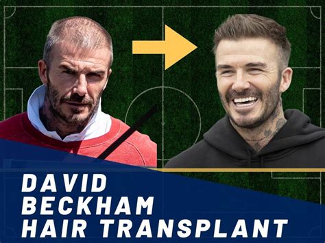 David Beckham Hair Transplant - Hair Loss & Technical Analysis