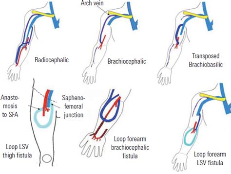 Duplex ultrasound scanning of the autogenous arterio venous ...