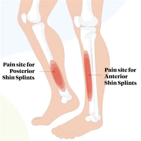 Shin Splints | Symptoms and Treatment Guide | QSMC