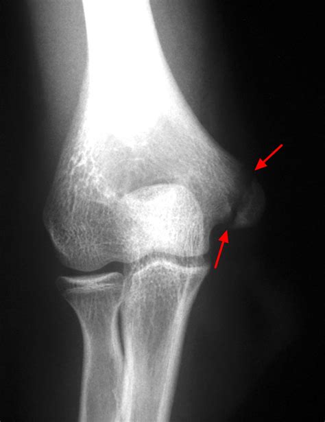 Growth Plate Fracture - Causes, Types, Symptoms,Treatment