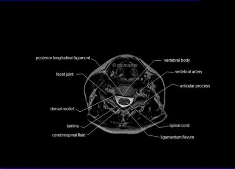 MRI spine anatomy | free MRI axial cervical spine anatomy | Mri ...