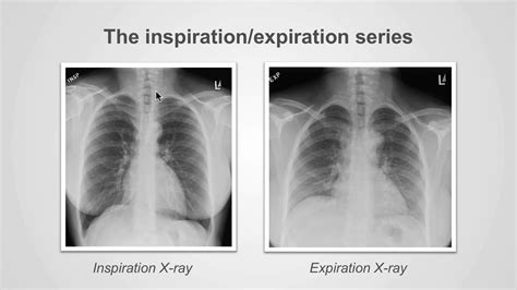 Types Of Chest X Ray