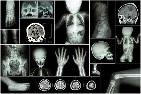 Brittle Bone Disease : Overview, Causes, Symptoms, Treatment - illness.com