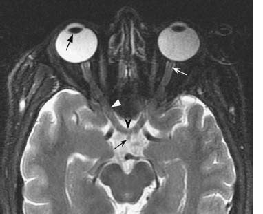 Normal Optic Nerve Mri