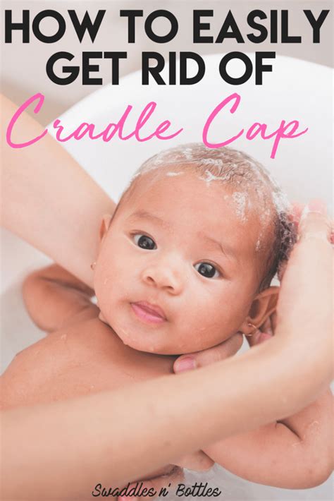 Fighting Cradle Cap- How to clear up your baby's scalp - Swaddles n ...