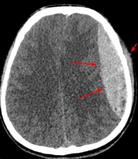 Epidural hematoma causes, signs, symptoms, diagnosis & treatment