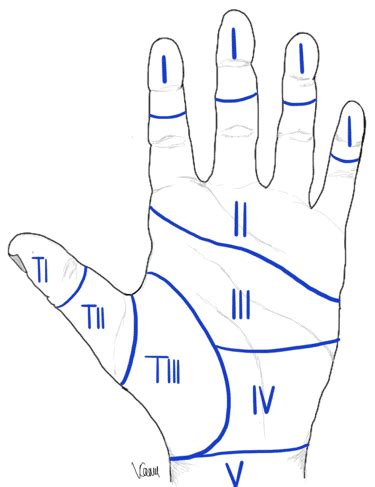 Flexor Tendon Zones Forearm