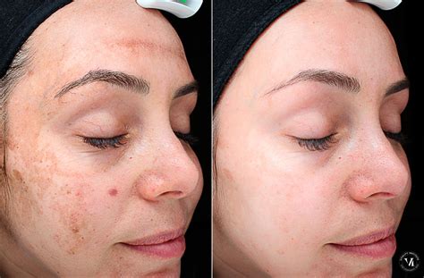 Chemical Peels Before and After photo gallery